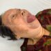 Case Lâm Sàng : Trường Hợp Phù Mạch Tích Lũy Bradykinin Do Dùng Thuốc Hạ Áp Nhóm Ức Chế Thụ Thể Angiotensin (ARB) Losartan 50mg