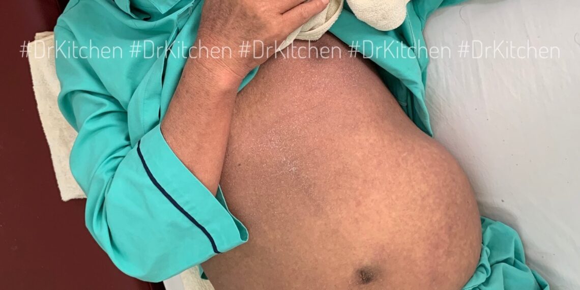 Một Trường Hợp Dị Ứng Allopurinol Sau 14 Ngày Dùng Thuốc Biễn Biến Hội Chứng Steven-Johnson