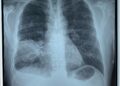 Case Lâm Sàng Bệnh Nhân Trẻ Tuổi Viêm Thùy Dưới Phổi Phải, Nhiễm Trùng Huyết Do Vi Khuẩn Burkholderia pseudomallei