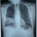 Case Lâm Sàng Bệnh Nhân Trẻ Tuổi Viêm Thùy Dưới Phổi Phải, Nhiễm Trùng Huyết Do Vi Khuẩn Burkholderia pseudomallei
